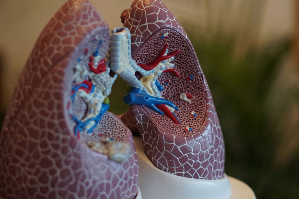 Bronchiectasis: Understanding the Condition, Its Causes, and New
